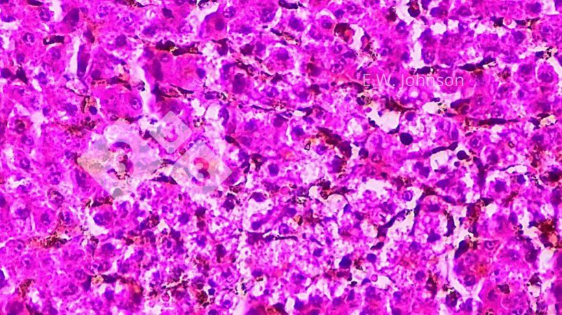 Imagem 4. Necrose hepática focal com ocasionais corpos de inclusão intranucleares anfofílicos na área perinecrótica. Fígado.